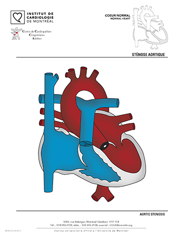Sténose aortique